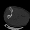 SPORK, NICO - 22.03.1976 - 02.08.2022 - CT obere Extremität - 17:51:17
